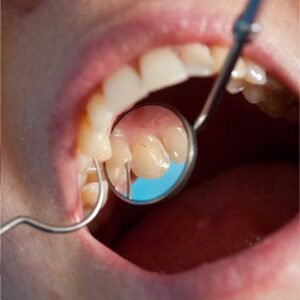 A dental diagram showing a root canal procedure, covered for adults under Medi-Cal at Mission Dental Care.