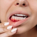 gum inflammation treatment oceanside ca, deep cleaning for bleeding gums oceanside, periodontitis treatment mission dental care.