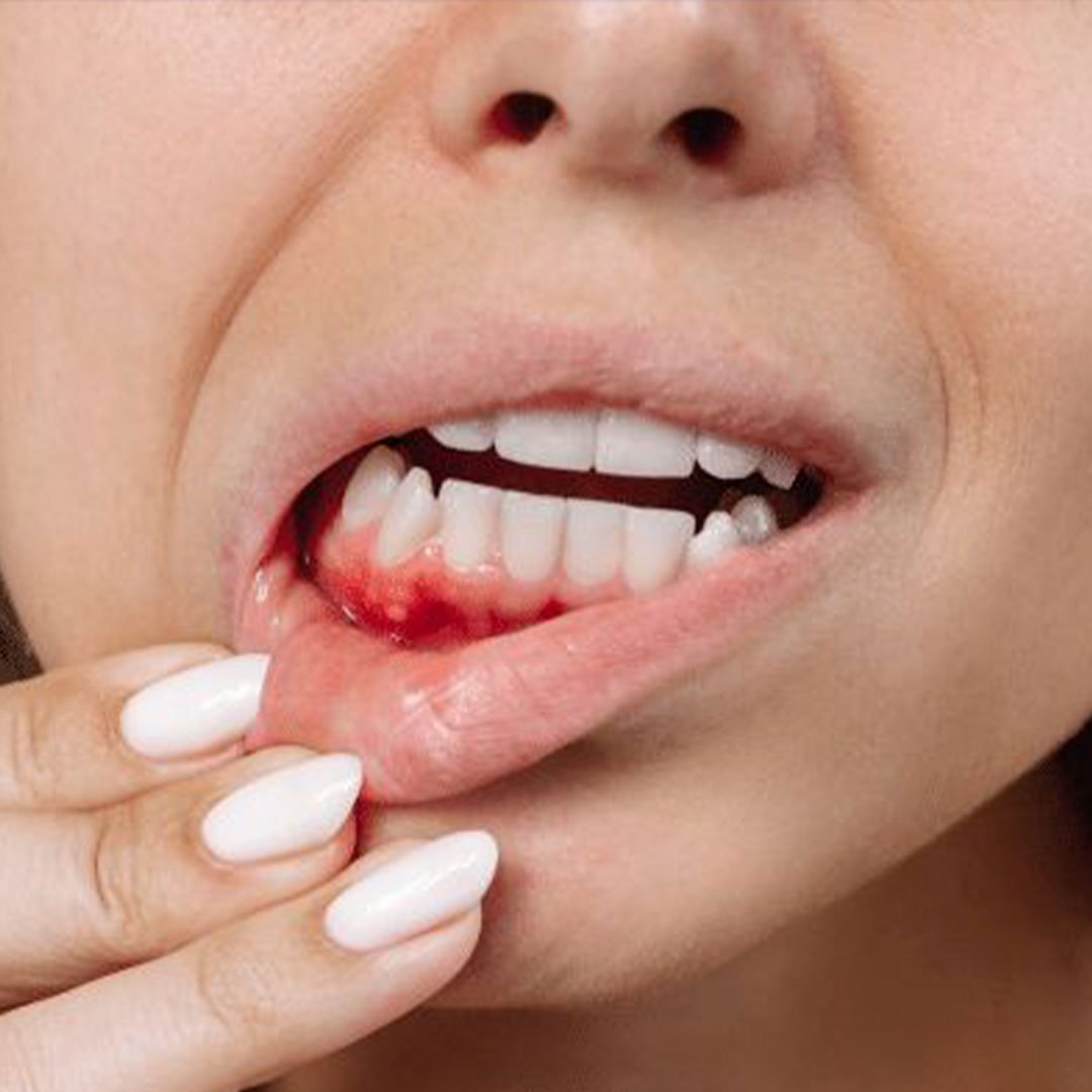 gum inflammation treatment oceanside ca, deep cleaning for bleeding gums oceanside, periodontitis treatment mission dental care.