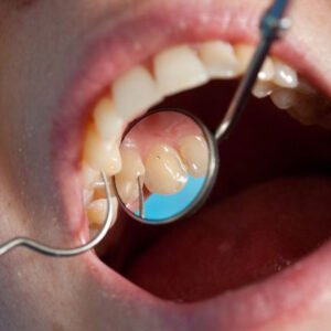 A dentist explaining root canal coverage to an adult patient with Medi-Cal in Oceanside, CA.