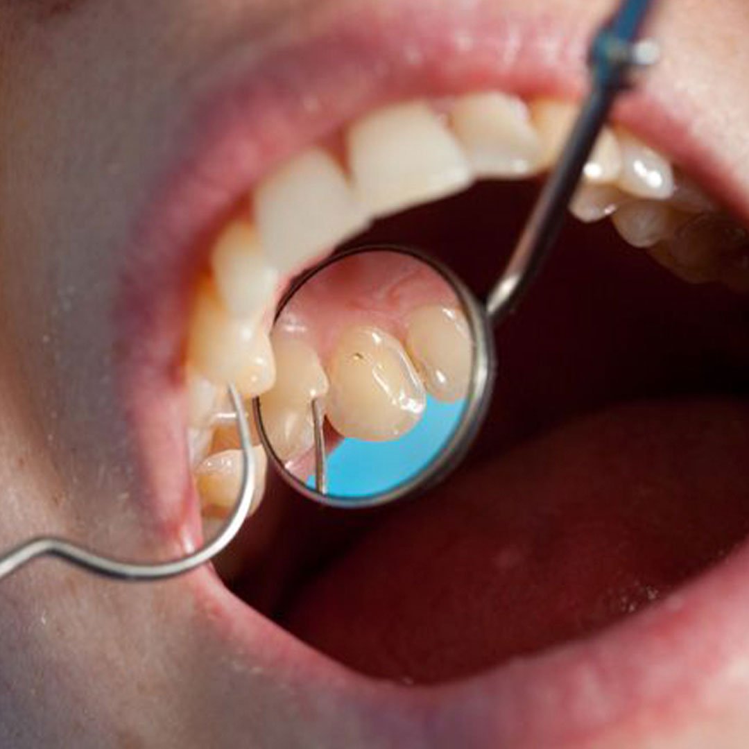 A dentist explaining root canal coverage to an adult patient with Medi-Cal in Oceanside, CA.